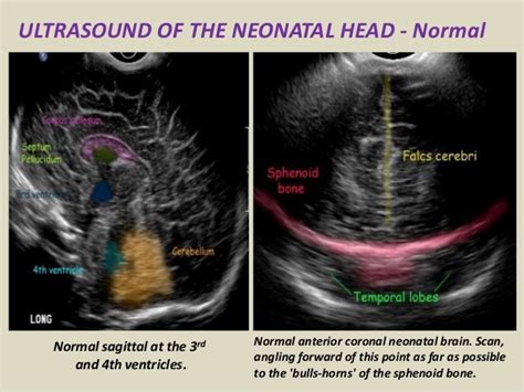 Neonatal Head Ultrasound Anatomy