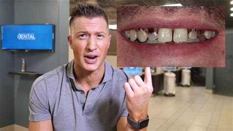 7 Reasons Why Your Crown Fell Off Emergency Dentists And Urgent After