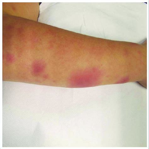 Two Months After The Initial Skin Eruption Clinical Examination