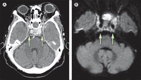 Cavernous Sinus Thrombosis Linking A Swollen Red Eye And Headache