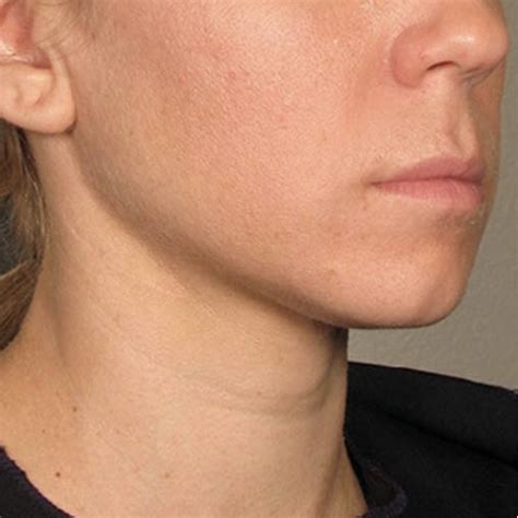 How To Tighten Your Jawline A Guide To Jawline Surgery Options