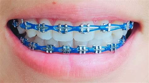 จัดฟันสีฟ้า เคลือบความสวยงามให้กับกลุ่มฟันที่น่าทึ่ง Vnpt Bình Dương