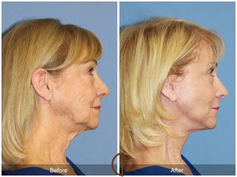 Neck Lift Before And After Photos Patient 35 Dr Kevin Sadati