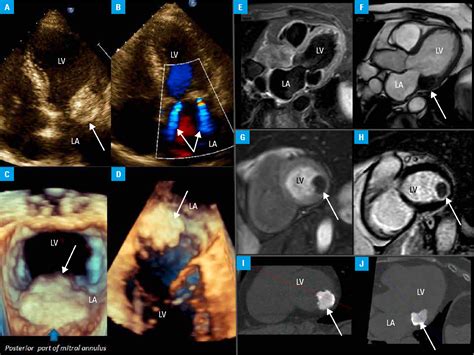 Figure 1 From Multimodal Diagnosis Of Caseous Calcification Of The