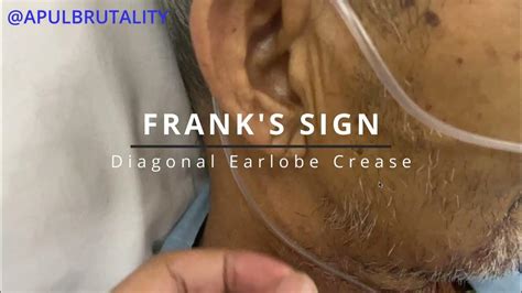 Franks Sign Diagonal Earlobe Crease Youtube