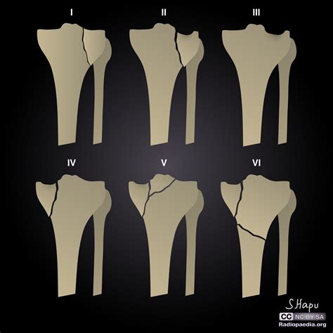 Tibial Plateau Fracture Classification Wikidoc