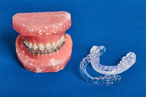 The Different Types Of Braces Mack Orthodontics