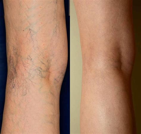 Laser Thread Vein Removal Spider Vein Removal Skin House Luton