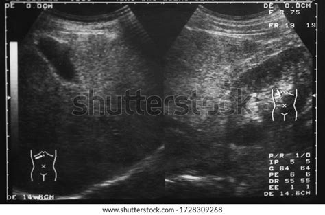 Whole Abdomen Ultrasound Scanhuman Film Xray Stock Photo 1728309268