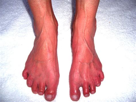 Erythromelalgia Is A Rare And Frequently Devastating Disorder That