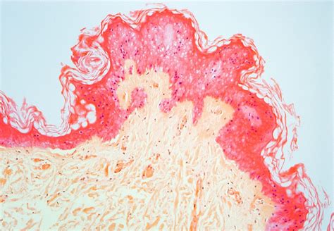 Skin Necrosislight Micrograph Bild Kaufen 11681517 Science Photo