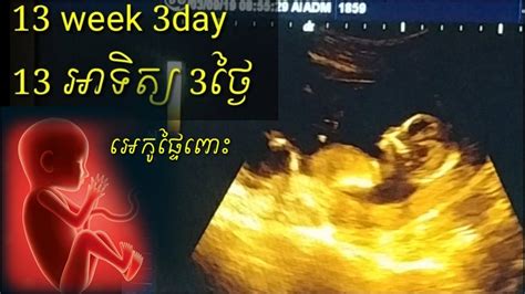 ពិនិត្យអេកូផ្ទៃពោះ 13អាទិត្យ 3ថ្ងៃ Pregnancy Ultrasound 13 Week 3 Day