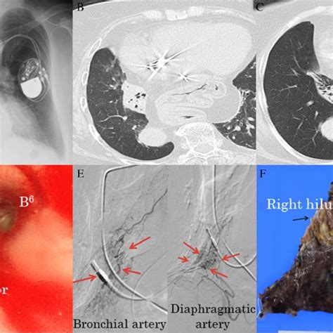 Pdf A Case Of Lung Tumorlets Secondary To Pulmonary Hypoplasia With