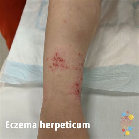 Eczema Herpeticum Skin Deep