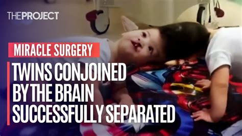 Twins Conjoined By The Brain Successfully Separated Youtube
