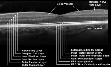 Spectralis Optical Coherence Tomography Oct Provides A Cross Section