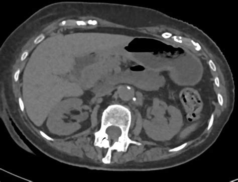 Transitional Cell Carcinoma Left Kidney Kidney Case Studies Ctisus