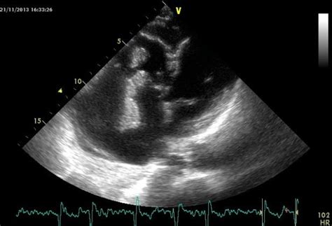 B Few Large Mobile Vegetations In Right Sided Infective Endocarditis