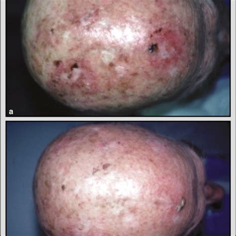 A Pre Treatment Baseline Photograph Of Extensive Actinic Keratoses Of