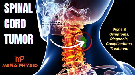 Spinal Cord Tumor Signs And Symptoms Diagnosis Complications