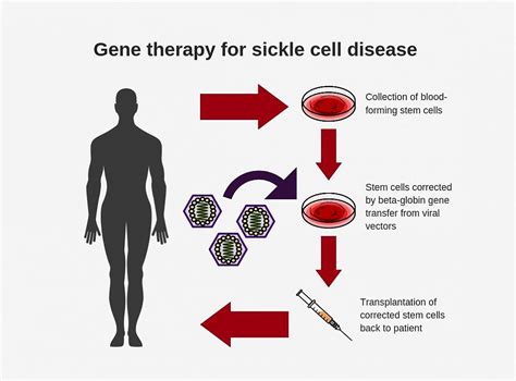 Forward Oriented Gene Therapy Improves Treatment For Sickle Cell Disease
