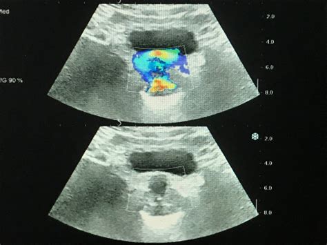 Vietnamese Medic Ultrasound Case 572 Prostate Cancer Dr Phan Thanh