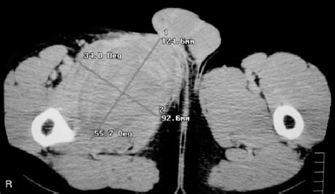 Initial Ct Images With Huge Extensive Groin Haematoma Without Active