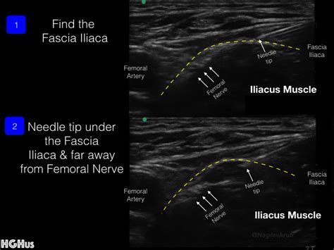 Femora Nerve Block — Highland Em Ultrasound Fueled Pain Management