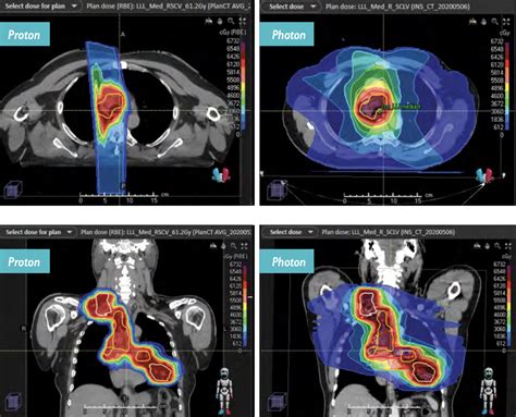 Proton Therapy Case Study—lung Cancer Johns Hopkins Medicine