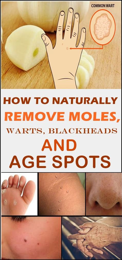 How To Naturally Remove Moles Warts Blackheads And Age Spots