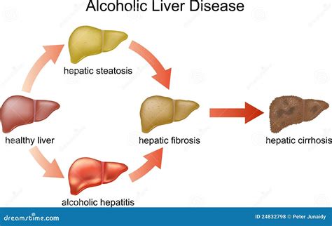 Alcoholic Liver Disease Faces