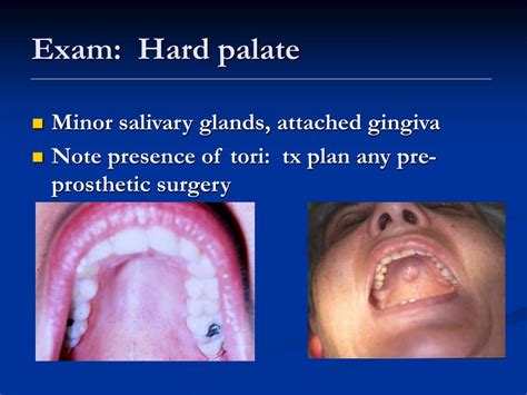 Ppt Examination Of The Oral Cavity Powerpoint Presentation Free