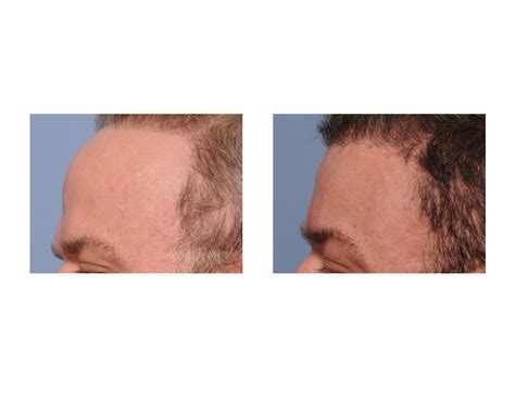 Plastic Surgery Case Study Total Forehead Reduction With Hairline
