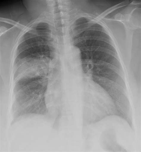 Cxr Consolidation Infiltrate Lungs