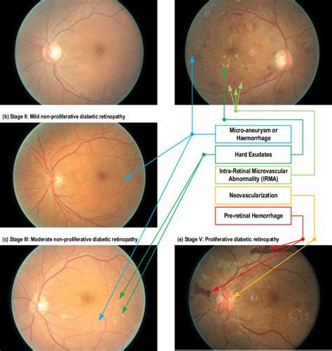 Fundoscopic Images Of Different Stages Of Diabetic Retinopathy A