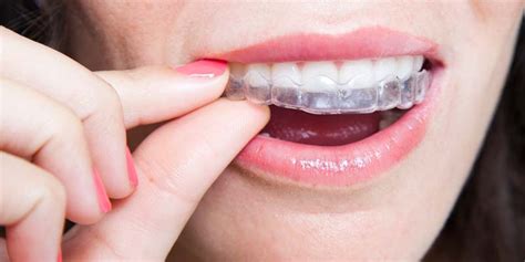 Invisalign Buck Teeth San Antonio Orthodontics Invisalign Clear Braces