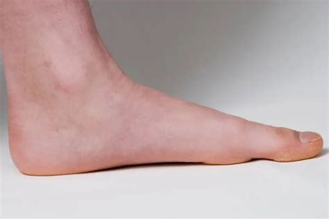 Flat Feet In Children Causes And Treatment Health 2024