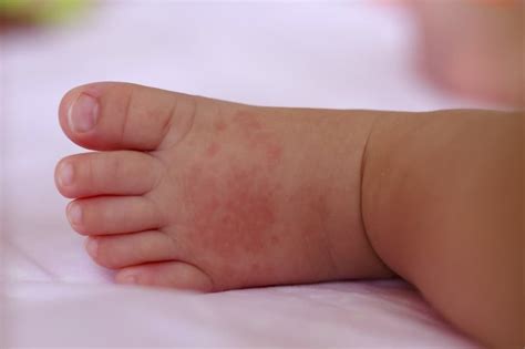 10 Common Triggers Of Baby Eczema — Little Botanics