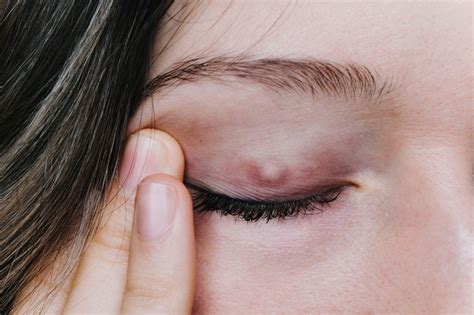Gradówka na oku Objawy przyczyny jak leczyć Porady w INTERIA PL