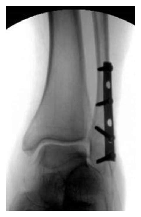 Immediate Weight Bearing After Ankle Fracture Fixation