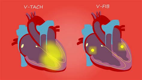 Si associa a cardiopatie aritmogene ereditarie con difetti a carico dei. Ventricular tachycardia and Ventricular fibrillation ...