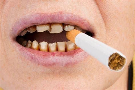 Cómo afecta el tabaco la salud de los dientes Mejor con Salud