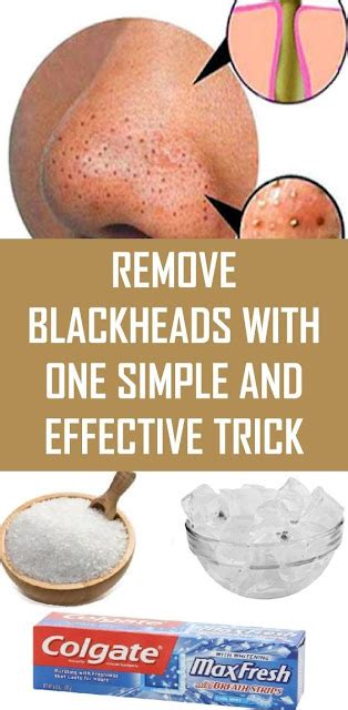 Remove Blackheads With One Simple And Effective Trick Wellness Week 104