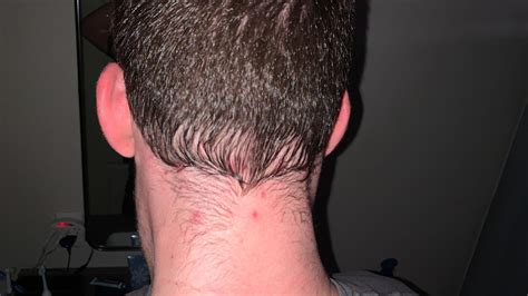 Painful Solid Red Bumps Back Of Head And Neck Hair Looks Like That