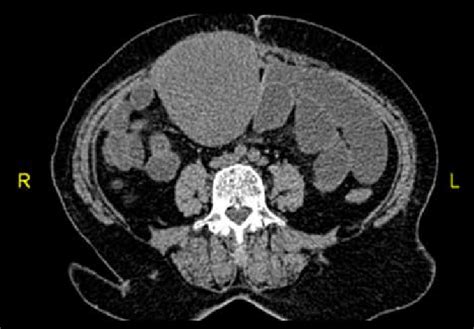Ct Scan Shows Intra Abdominal Extension Of The Desmoid Tumor Which Is