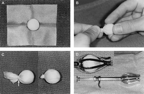 The Use Of Vicryl Mesh In 200 Porous Orbital Implants A Tec