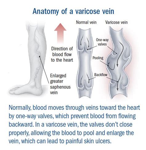 Varicose Veins Guide Causes Symptoms And Treatment Options