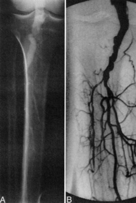 Popliteal Artery Aneurysms Current Management And Outcome Journal Of