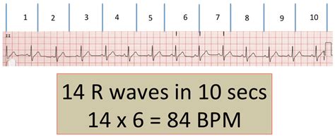 Cara Menghitung Heart Rate Ekg Dunia Sosial