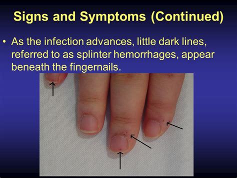 Aggregate 106 Endocarditis Symptoms Nails Latest Noithatsivn